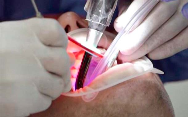 laser whitening in cancun