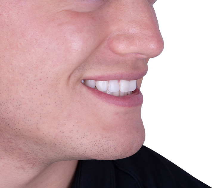 side picture of aligned teeth