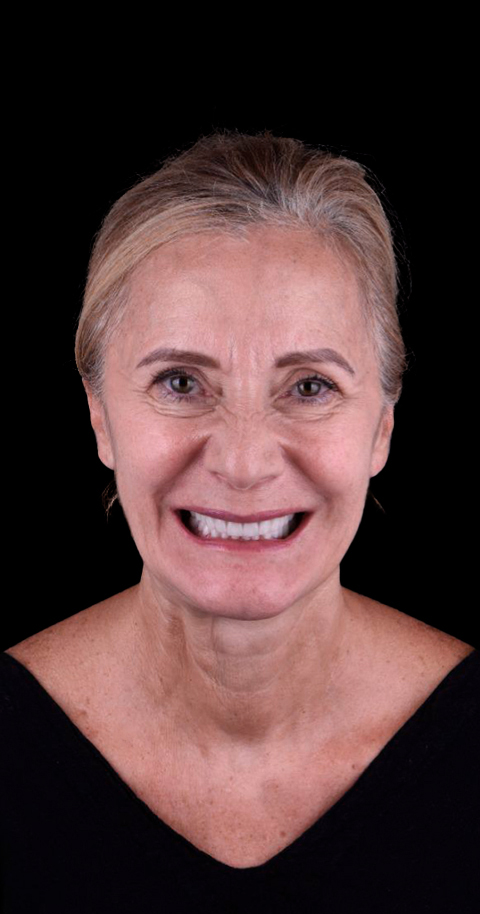 snap in dentures in mexico bafore and after