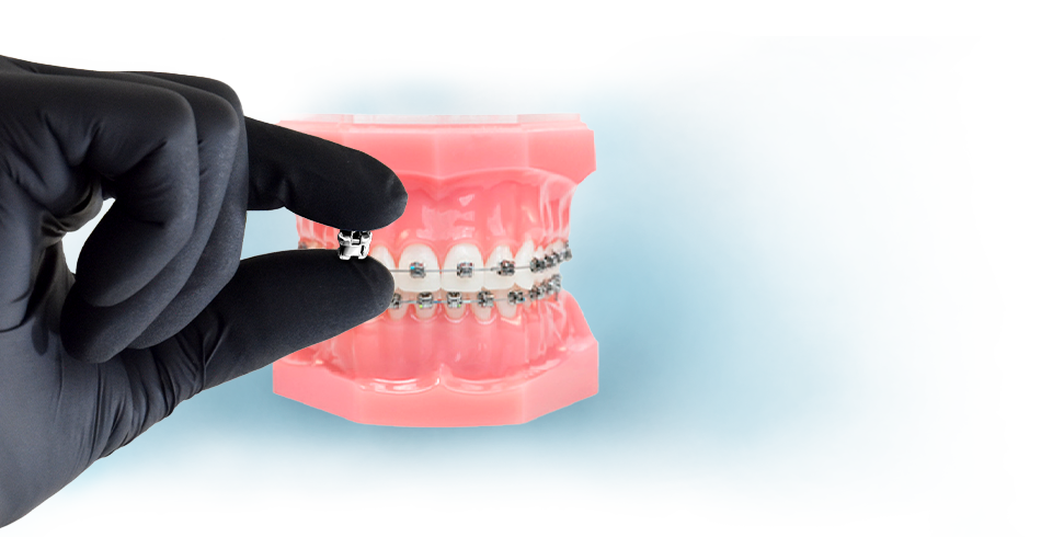 traditional metal braces in mexico